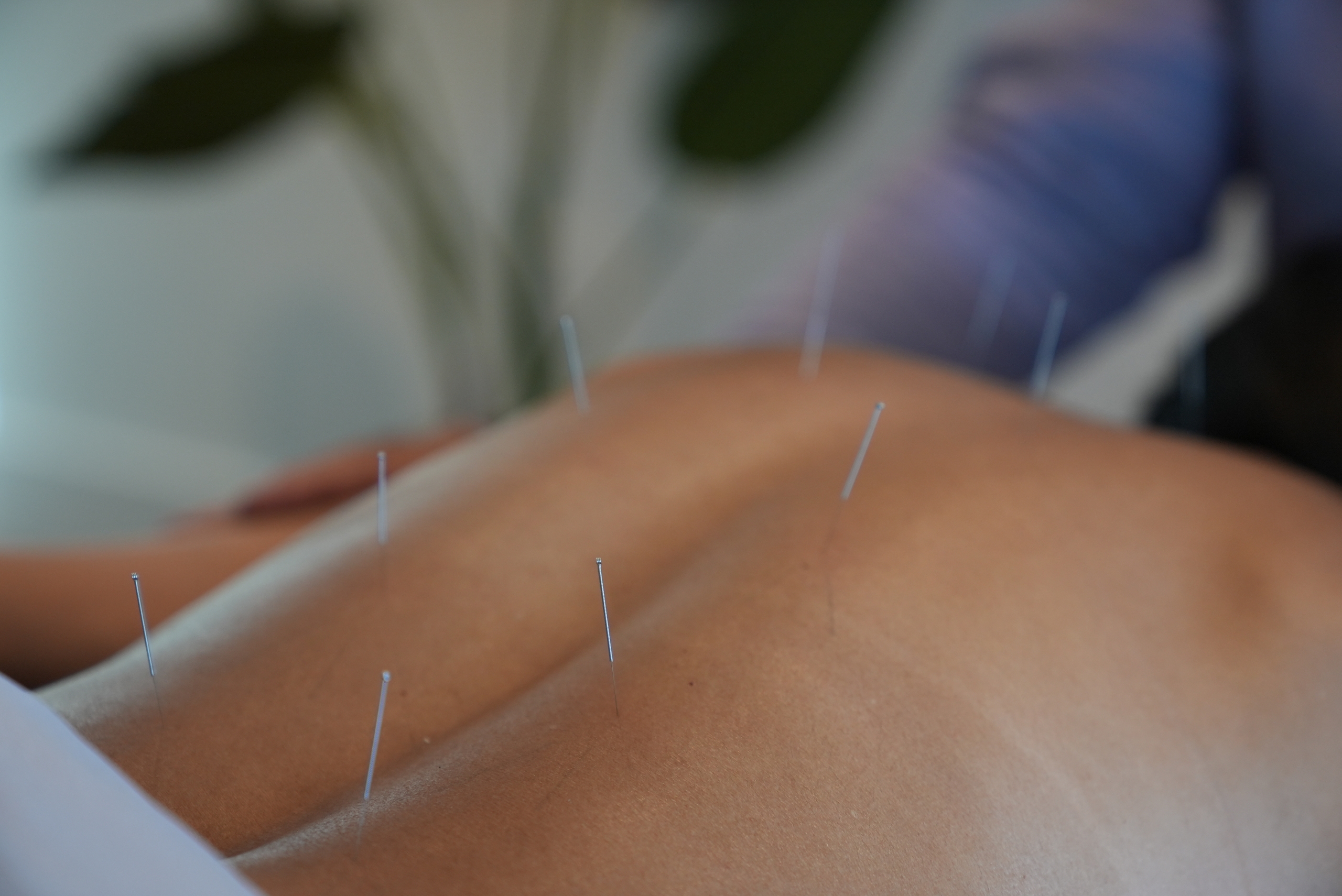 Acupuncture